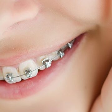 Caring for Braces Before and After Orthodontic Appointments